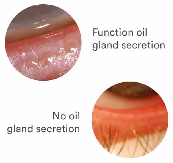 MDG Oil Secretion comparison