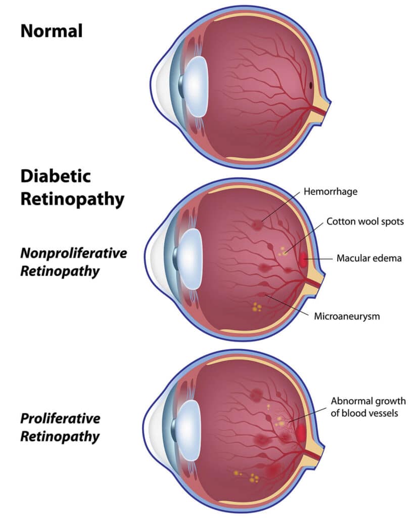 Diabetic Retinopathy Diagram